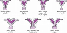 Image result for uterus bicornis bicollis. Size: 216 x 106. Source: doctorlib.info