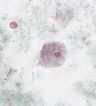 Image result for "heterochromia Fragilis". Size: 96 x 106. Source: www.cdc.gov
