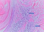 Afbeeldingsresultaten voor Lichen spinulosus Histology. Grootte: 145 x 106. Bron: www.cureus.com