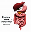Afbeeldingsresultaten voor Ileocecal valve. Grootte: 103 x 106. Bron: abdominaladhesiontreatment.com