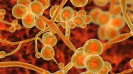 Image result for "torrea Candida". Size: 191 x 106. Source: newsnetwork.mayoclinic.org