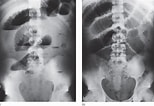 Afbeeldingsresultaten voor "grammatostomias Circularis". Grootte: 154 x 106. Bron: radiologykey.com