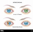 Image result for "heterochromia Fragilis". Size: 110 x 106. Source: www.alamy.es