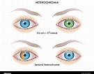 Image result for "heterochromia Fragilis". Size: 135 x 106. Source: www.alamy.com