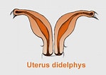 Bildergebnis für Uterus Didelphys. Größe: 149 x 106. Quelle: www.babycenter.ca