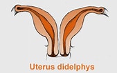Image result for Uterus Didelphys. Size: 169 x 106. Source: www.babycenter.ca