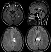 Image result for Corpus Callosum Mrt. Size: 104 x 106. Source: www.researchgate.net