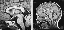 Image result for Corpus Callosum Mrt. Size: 224 x 106. Source: www.ajnr.org