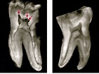 3rd Molar dental pulp Cells के लिए छवि परिणाम. आकार: 141 x 106. स्रोत: pocketdentistry.com