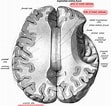 Image result for Corpus Callosum Beschriftung. Size: 111 x 106. Source: www.ars-neurochirurgica.com