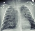 Image result for posttraumatische Pneumatocele Im Ligamentum Pulmonale Inferior. Size: 119 x 106. Source: www.researchgate.net