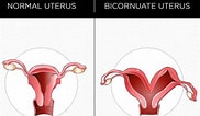 Image result for uterus bicornis bicollis. Size: 182 x 106. Source: healthjade.com