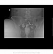 Image result for Uterus Didelphys. Size: 108 x 110. Source: radiopaedia.org