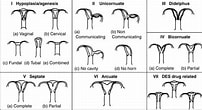 Image result for Uterus Didelphys. Size: 202 x 110. Source: www.babymed.com
