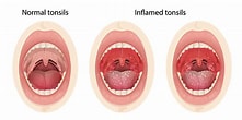 Biletresultat for normal Tonsil Strep Throat. Storleik: 221 x 110. Kjelde: www.lakeshoreent.com