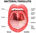 Biletresultat for normal Tonsil Strep Throat. Storleik: 120 x 110. Kjelde: www.georgemurty.co.uk