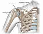 Synovialsarkom Schultergelenk に対する画像結果.サイズ: 150 x 120。ソース: www.implantcast.de