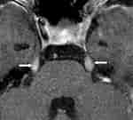 Image result for Meningeosis neoplastica Röntgenaufnahme. Size: 150 x 135. Source: pacs.de
