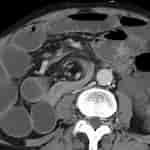 Image result for whirlpool Zeichen volvulus. Size: 150 x 150. Source: www.wikidoc.org
