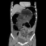 Image result for whirlpool Zeichen volvulus. Size: 150 x 150. Source: www.pinterest.com