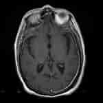 Image result for Meningeosis neoplastica Röntgenaufnahme. Size: 150 x 150. Source: radiopaedia.org
