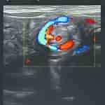 Image result for whirlpool Zeichen volvulus. Size: 150 x 150. Source: www.researchgate.net