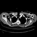 Image result for Normvariante der Arteria vertebralis Mit Kurzstreckiger Doppelung. Size: 150 x 150. Source: pacs.de