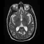 Image result for Meningeosis neoplastica Röntgenaufnahme. Size: 150 x 150. Source: radiopaedia.org
