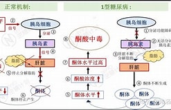 Image result for 酮酸中毒. Size: 247 x 160. Source: zhuanlan.zhihu.com