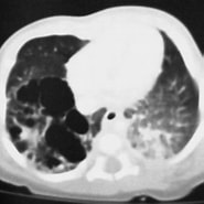 Bildergebnis für CCAM Zystisch adenomatoide Malformation der Lunge im fetalen MRT. Größe: 185 x 185. Quelle: www.kidsdoc.at