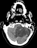 Image result for Kleinhirninfarkt in Einem Kind. Size: 143 x 185. Source: www.ars-neurochirurgica.com