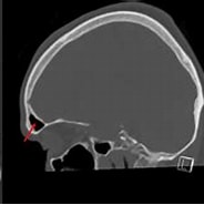 Image result for Hirnabszesse Bei Angeborenem Defekt Der Sinus frontalis. Size: 184 x 120. Source: www.ars-neurochirurgica.com