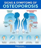Afbeeldingsresultaten voor Osteoporosis Agency Environ. Grootte: 160 x 185. Bron: www.pinterest.pt
