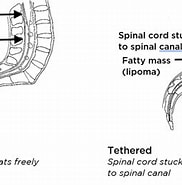 Image result for Tethered Spinal Cord Mit Einschluss-tm. Size: 182 x 185. Source: www.seattlechildrens.org