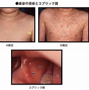Image result for 修飾麻疹. Size: 184 x 185. Source: medical.jiji.com