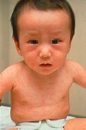 Image result for 修飾麻疹. Size: 122 x 185. Source: www.ann.hi-ho.ne.jp