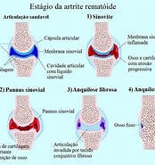 Image result for Reumatismo Articular agudo. Size: 174 x 185. Source: www.fisioterapiaparatodos.com