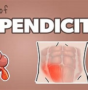 Image result for Appendizitis Punkte. Size: 181 x 180. Source: healthandwillness.org