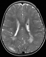 Image result for Tuberoese Hirnsklerose Mit Hemimegalencephalie. Size: 150 x 185. Source: de.academic.ru