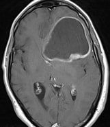 Image result for Glioblastoma Multiforme Bei Einem Neugeborenen. Size: 161 x 185. Source: healthjade.net