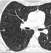 Bildergebnis für Lymphangioleiomyomatosis CT. Größe: 176 x 185. Quelle: radiologykey.com