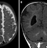Image result for Tuberoese Hirnsklerose Mit Hemimegalencephalie. Size: 181 x 185. Source: www.researchgate.net