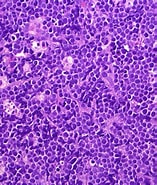 Image result for Burkitt Lymphom Endemisch. Size: 157 x 185. Source: www.mypathologyreport.ca