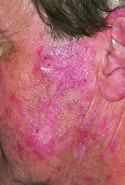 Image result for Systemischer Lupus erythematodes mit Knochennekrosen. Size: 125 x 185. Source: www.msdmanuals.com