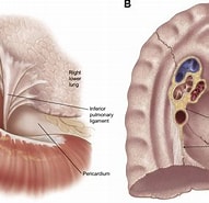 Image result for Posttraumatische Pneumatocele Im Ligamentum Pulmonale Inferior. Size: 191 x 185. Source: www.semanticscholar.org