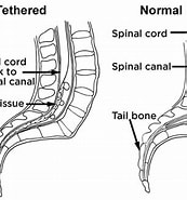Image result for Tethered Spinal Cord Mit Einschluss-tm. Size: 173 x 185. Source: healthjade.com
