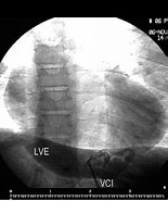 Image result for polysplenia syndrome Mit azygous Kontinuitaet Der Vene cava Superior intestinal Malrotation Kurzes Pankreas Und Praeduodenale vena Portae. Size: 155 x 185. Source: www.semanticscholar.org