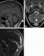 Image result for Submuköses Hämangiom der subglottischen trachea. Size: 145 x 185. Source: pacs.de