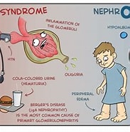 Image result for Invitae Nephrotic Syndrome. Size: 183 x 175. Source: www.medcomic.com