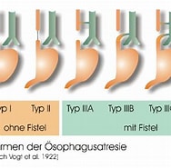 Image result for SCHLÜSSEL als ungewöhnlicher Ösophagus-fremdkörper in einem Neugeborenen. Size: 188 x 185. Source: www.medizin-kompakt.de